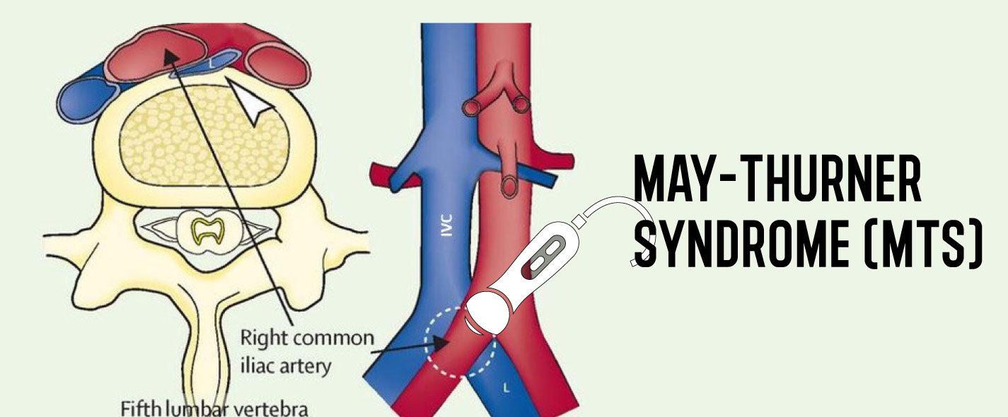 May-Thurner syndrome