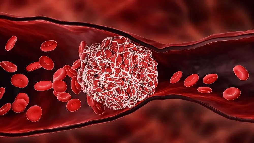 5 tips to prevent blood clotting