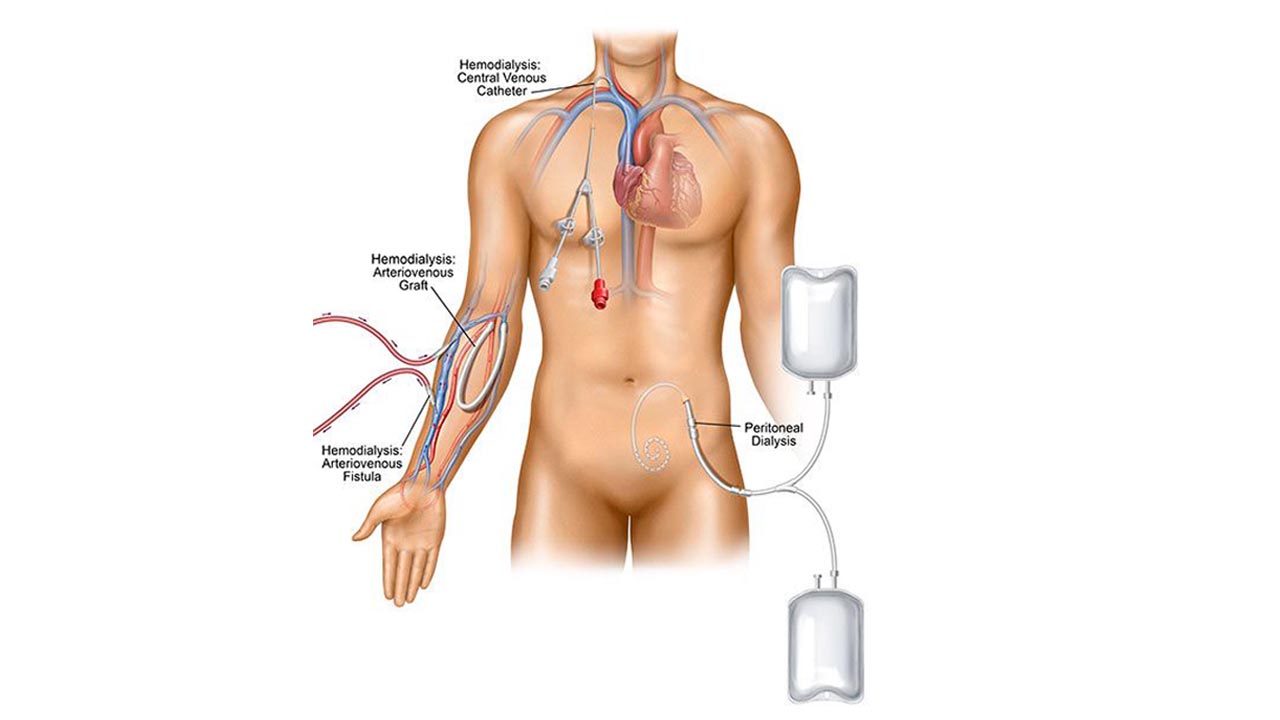 Dialysis Catheter Placement