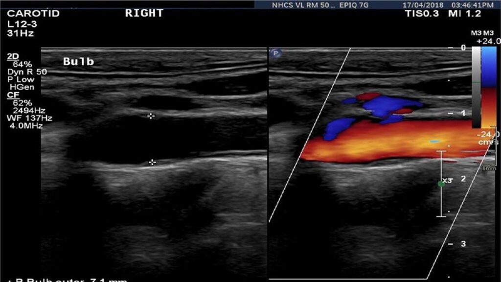 what-is-duplex-ultrasound-vascular-health