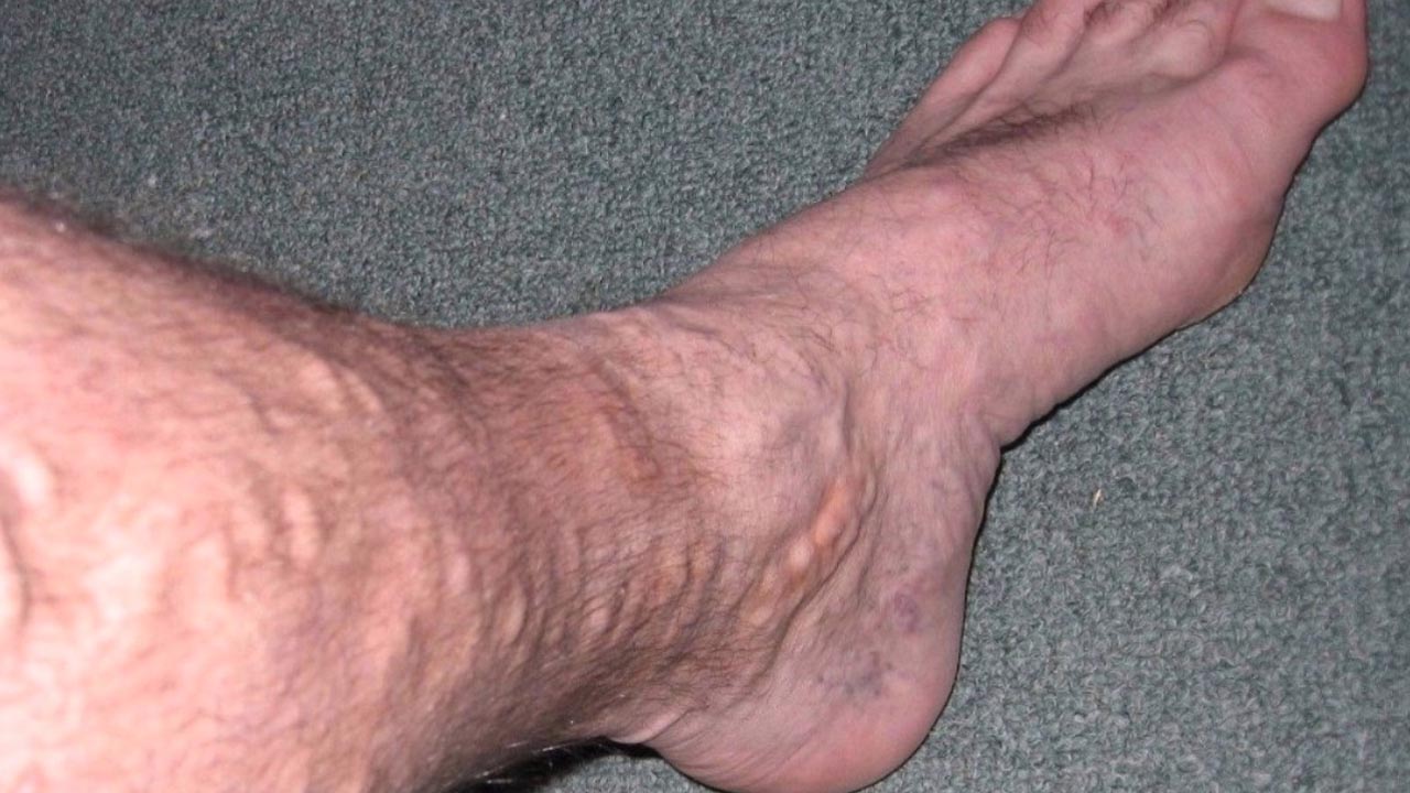 Varicose Veins and Cancer
