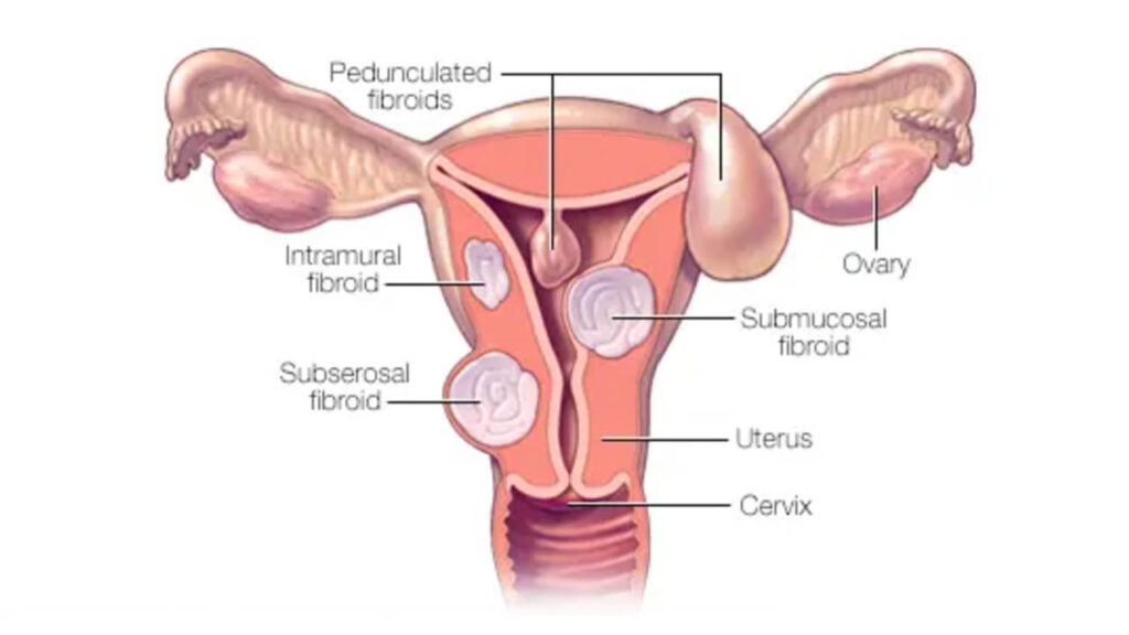 How Can Uterine Fibroids Affect Fertility and Pregnancy?