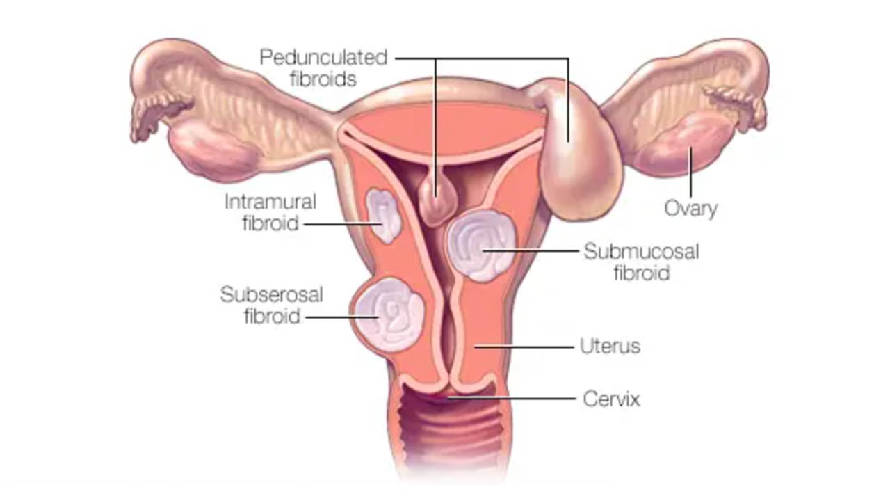 How Can Uterine Fibroids Affect Fertility and Pregnancy?