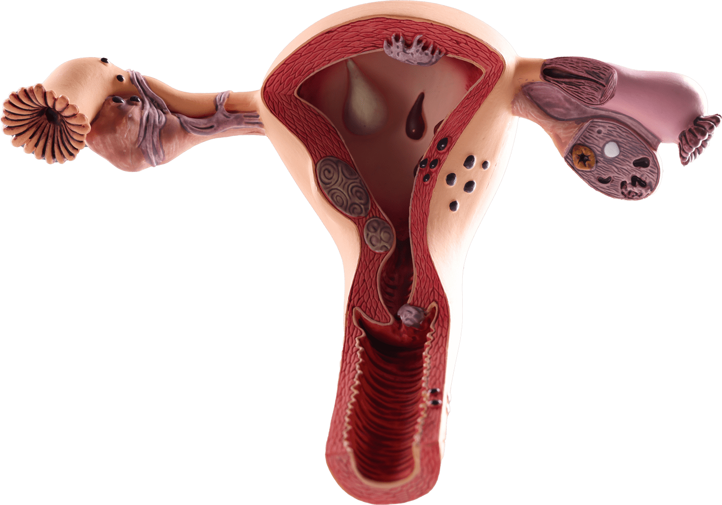 Uterine Fibroid Treatment In New Jersey Vascular Health