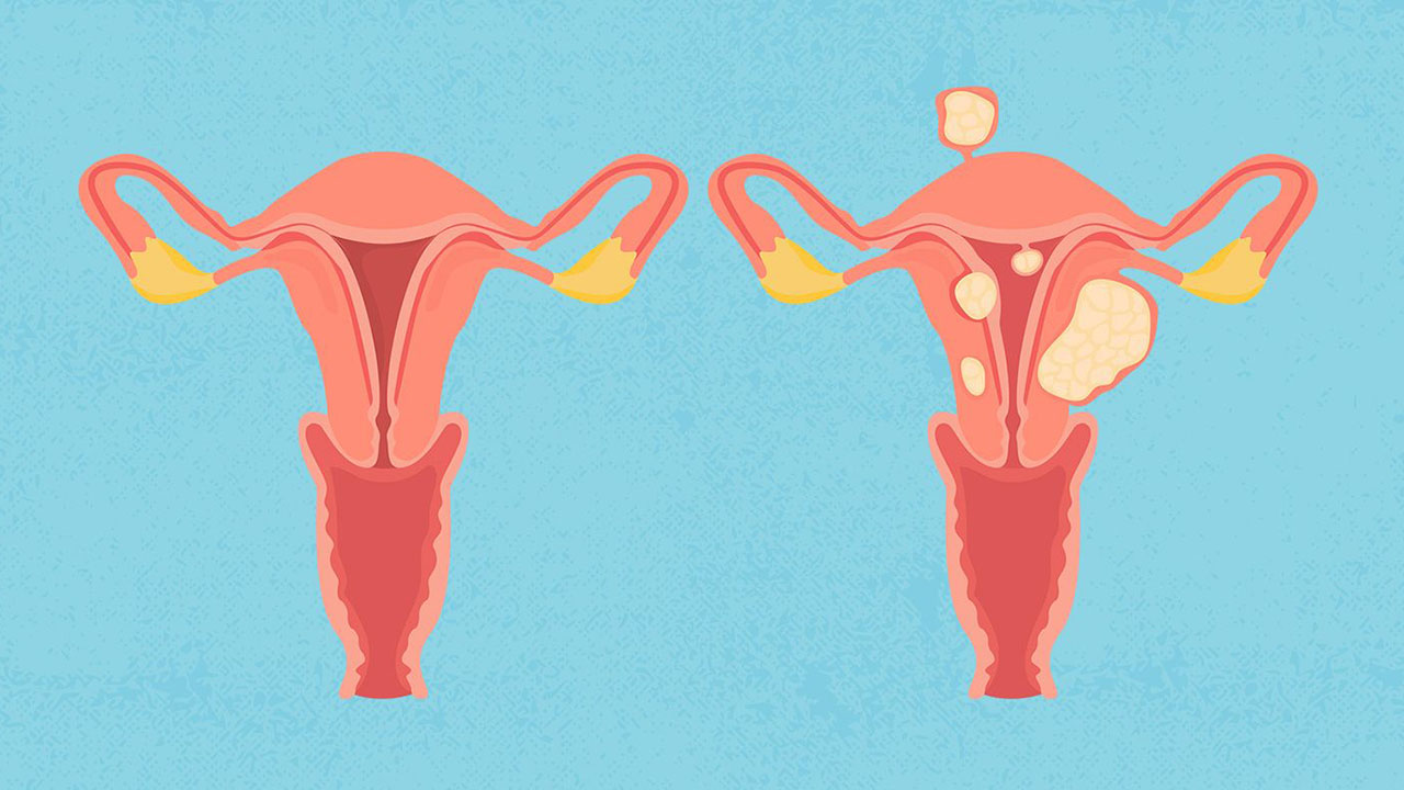 effects of fibroids on the menstrual cycle