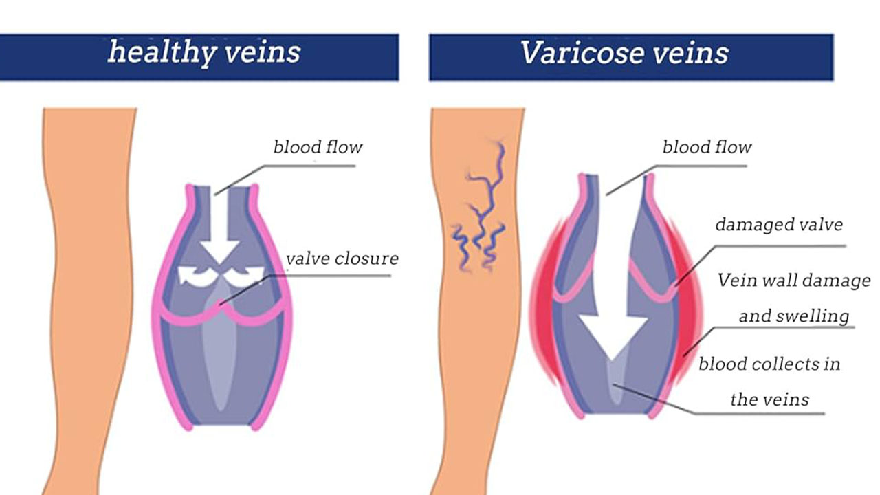 Varicose Veins and Blood Clots