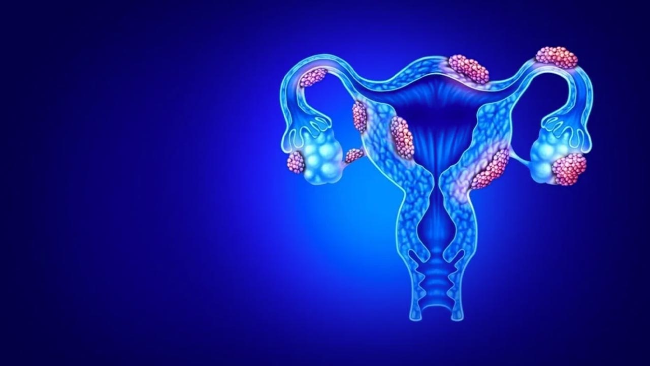 Difference Between Fibroids and Endometriosis