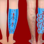 Are Varicose Veins Curable Without Surgery?