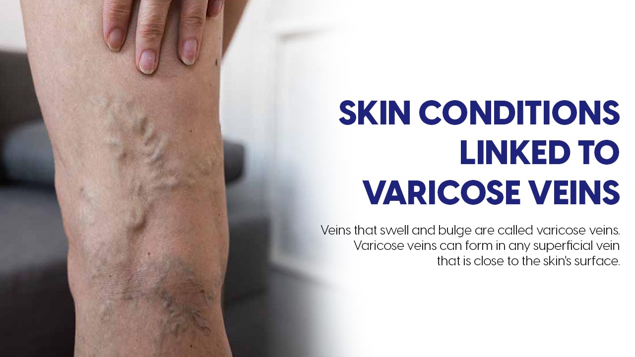 Skin Conditions Linked to Varicose Veins