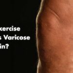 What Exercise Relieves Varicose Vein Pain?