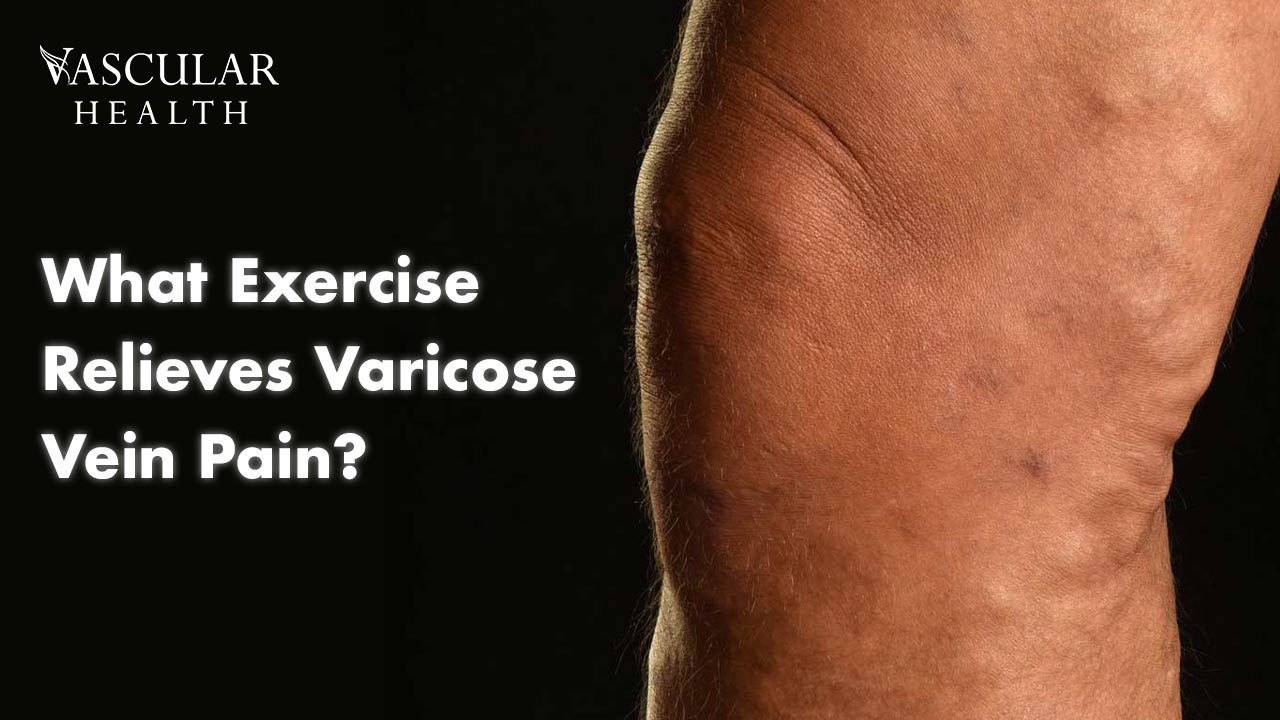 What Exercise Relieves Varicose Vein Pain?