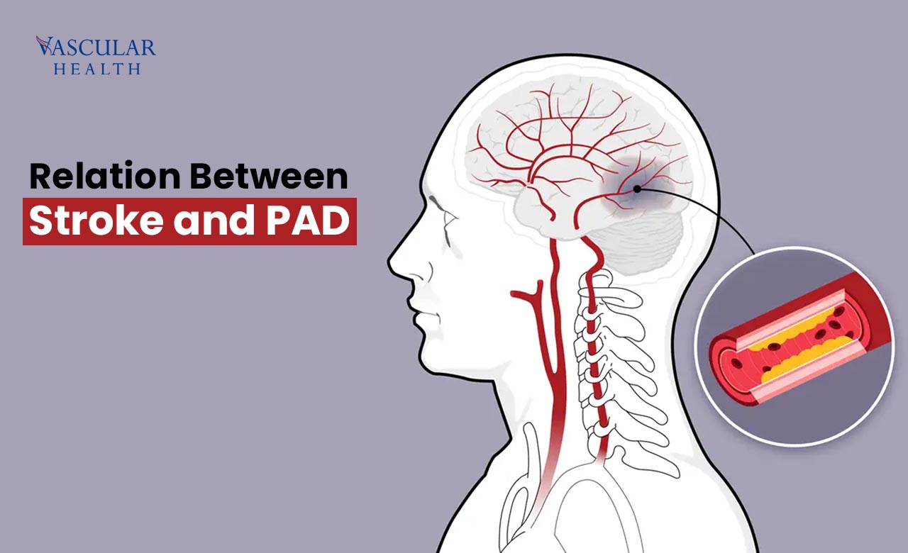 Stroke and PAD