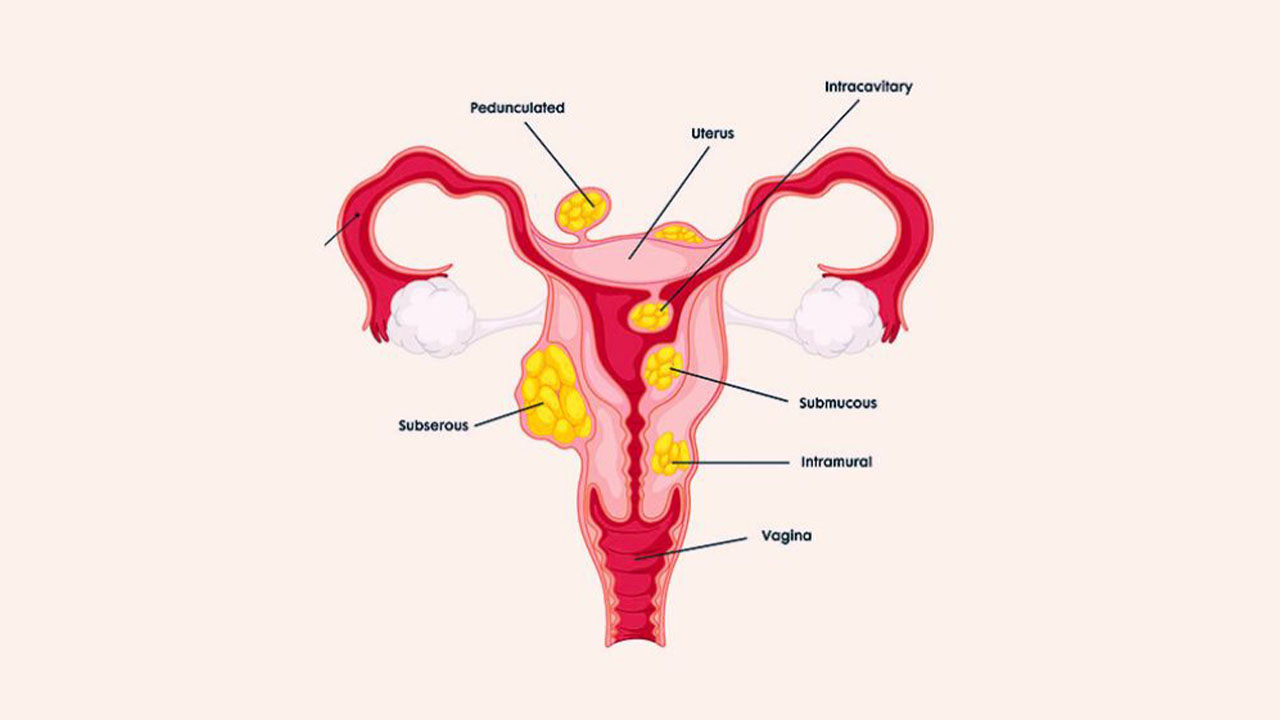 Intramural Fibroids