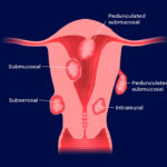 Submucosal Fibroids