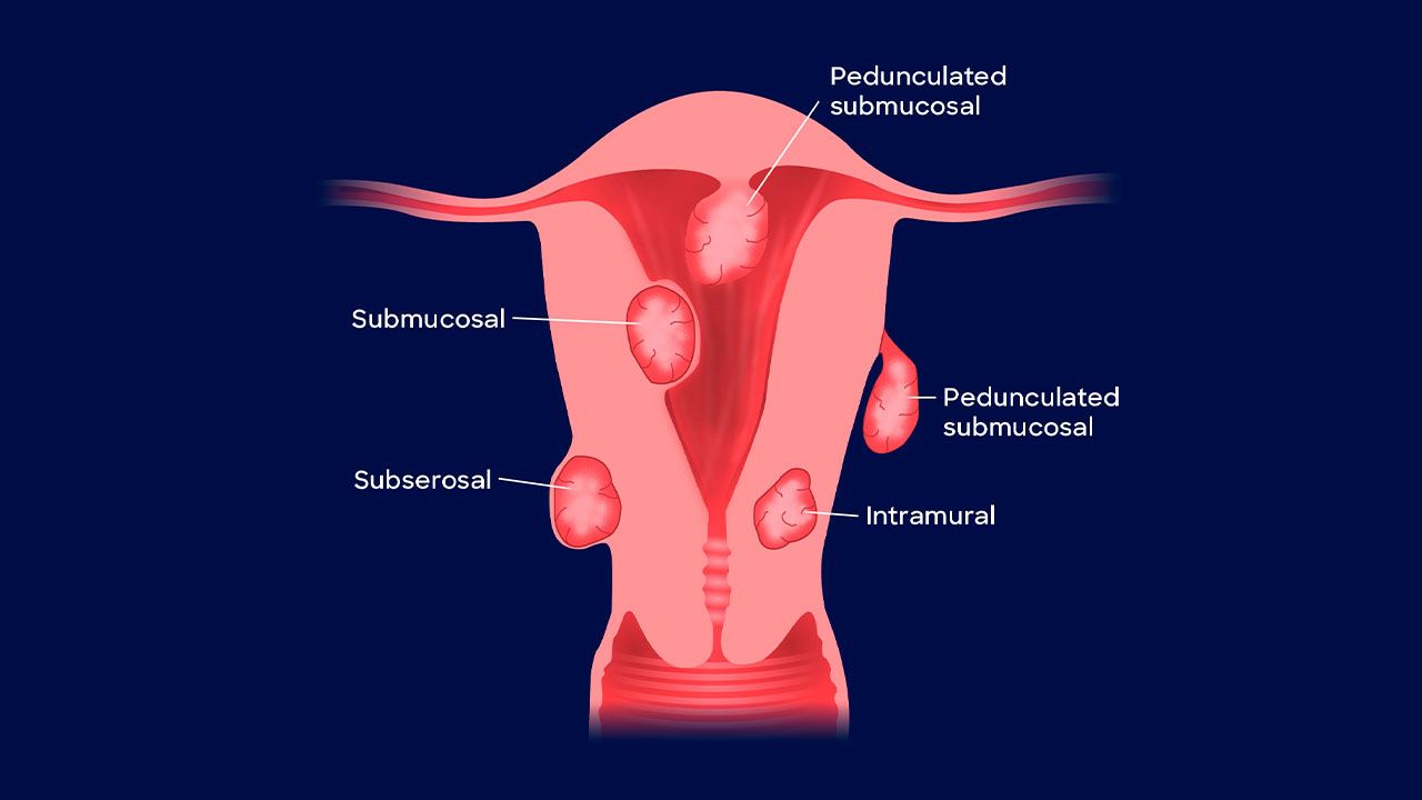 Submucosal Fibroids