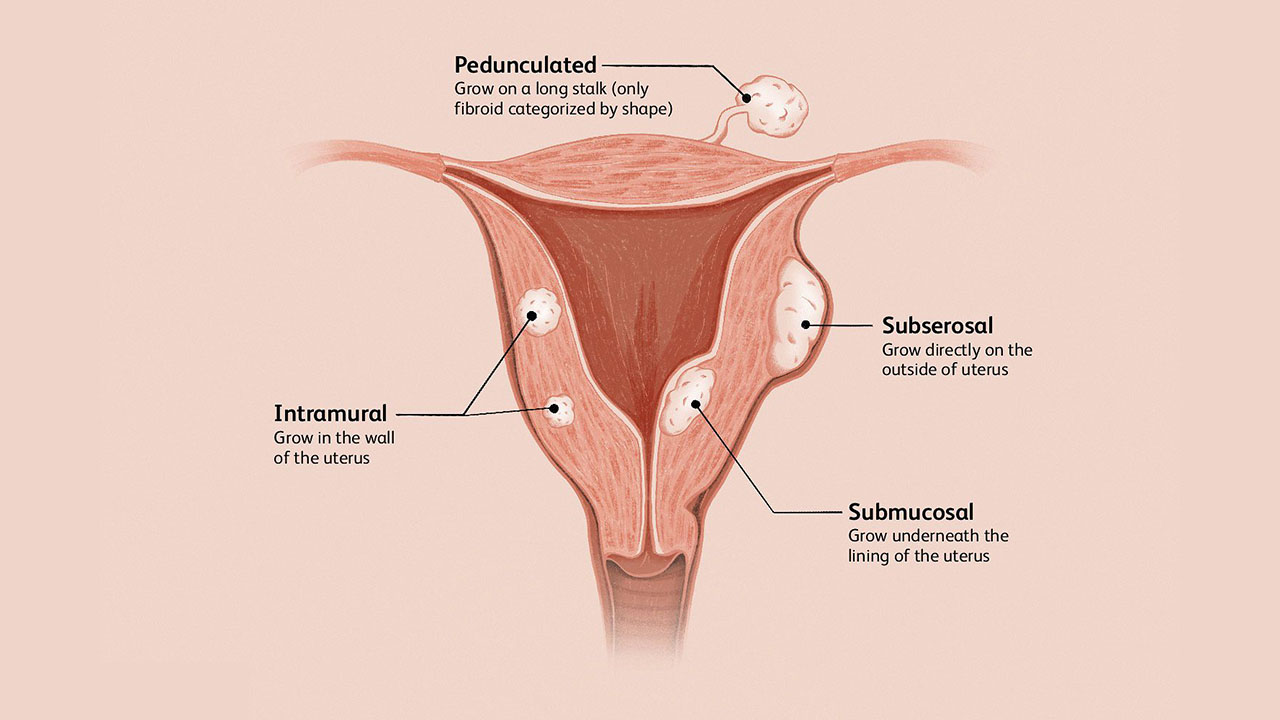 Subserosal Fibroids