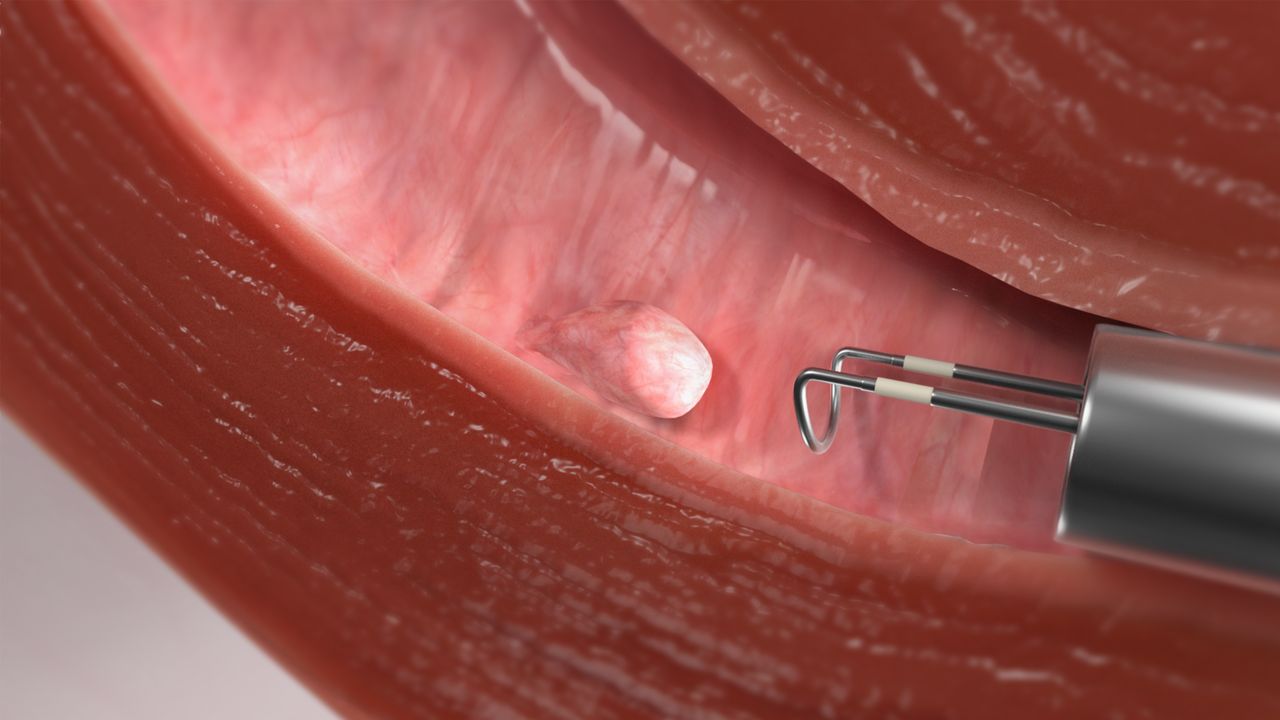 Uterine Fibroid Vs Uterine Polyps