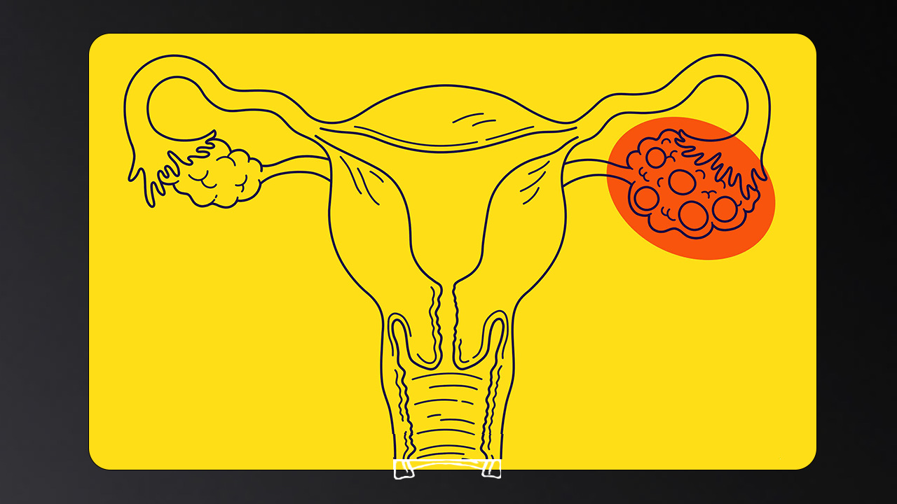 PCOS and Fibroids