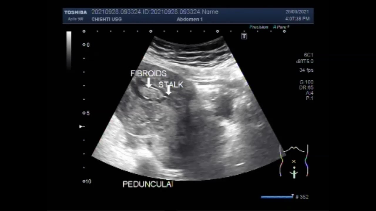 Pedunculated Fibroids